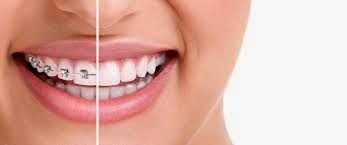 Метод «Инвизилайн» (Invisalign) в Стоматологии